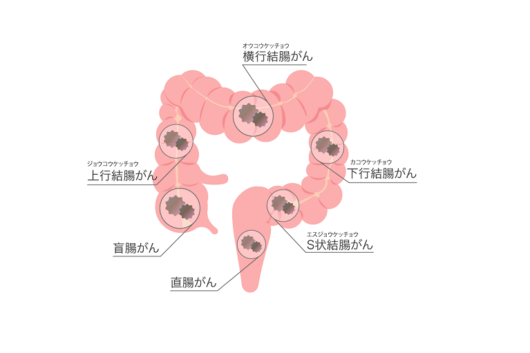 大腸がんとは？