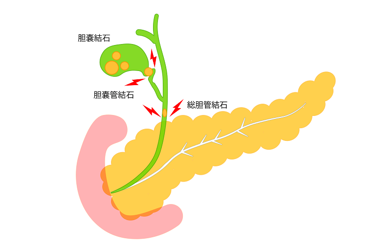 胆石・胆石症とは？