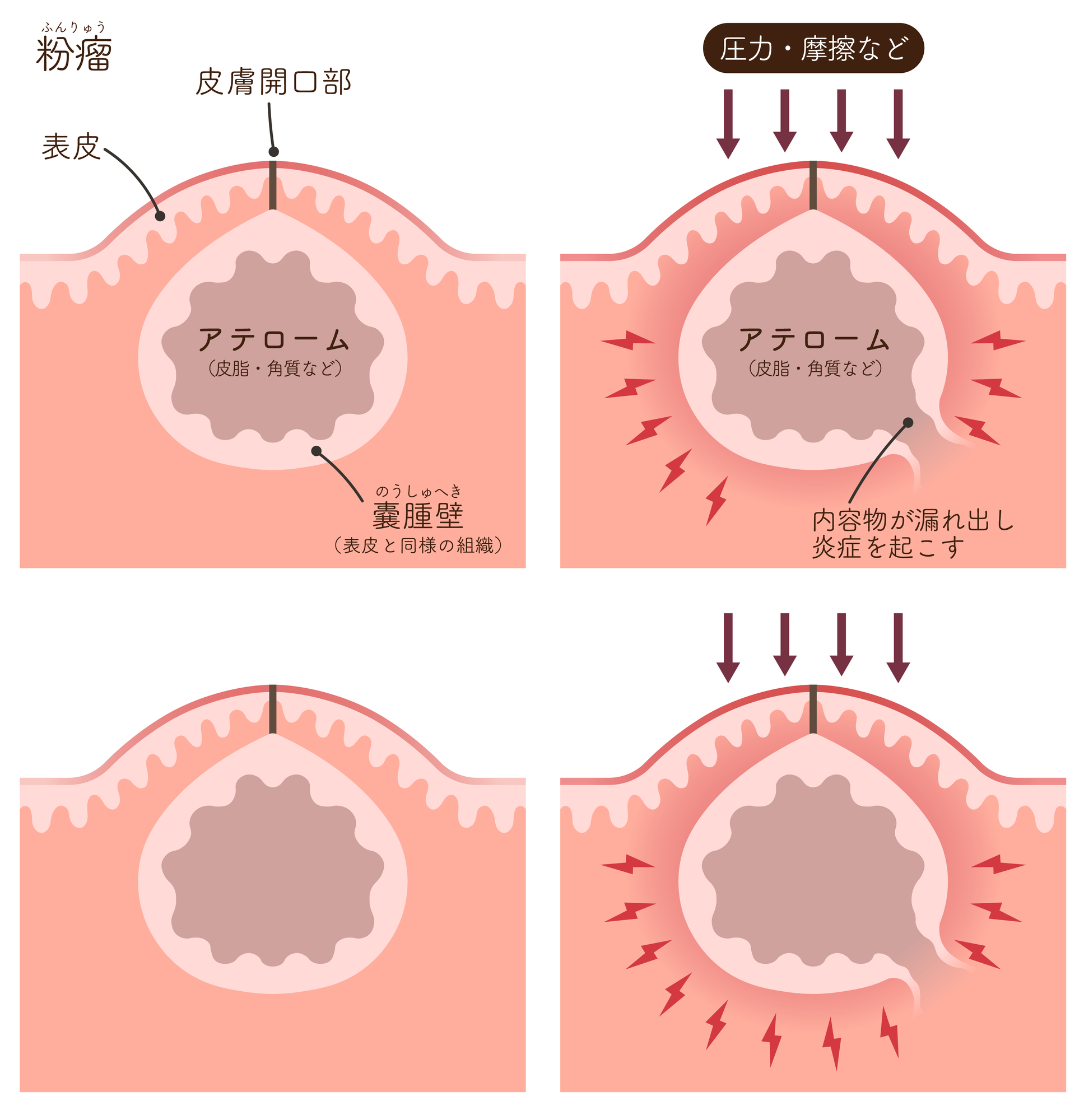 粉瘤（アテローム）の原因